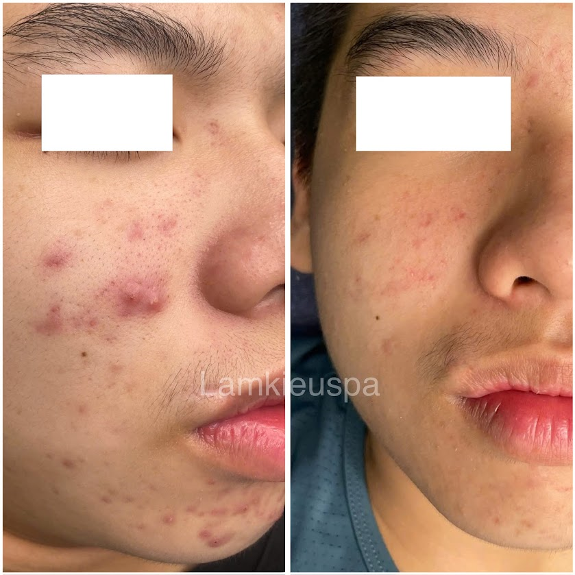 Chăm sóc da mụn tại Spa Lâm Kiều Vũng Tàu