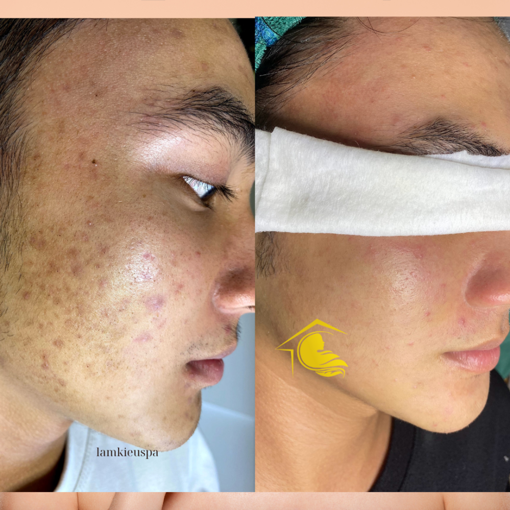 Tình trạng mụn viêm trước và sau khi chăm sóc tại Tây Ninh