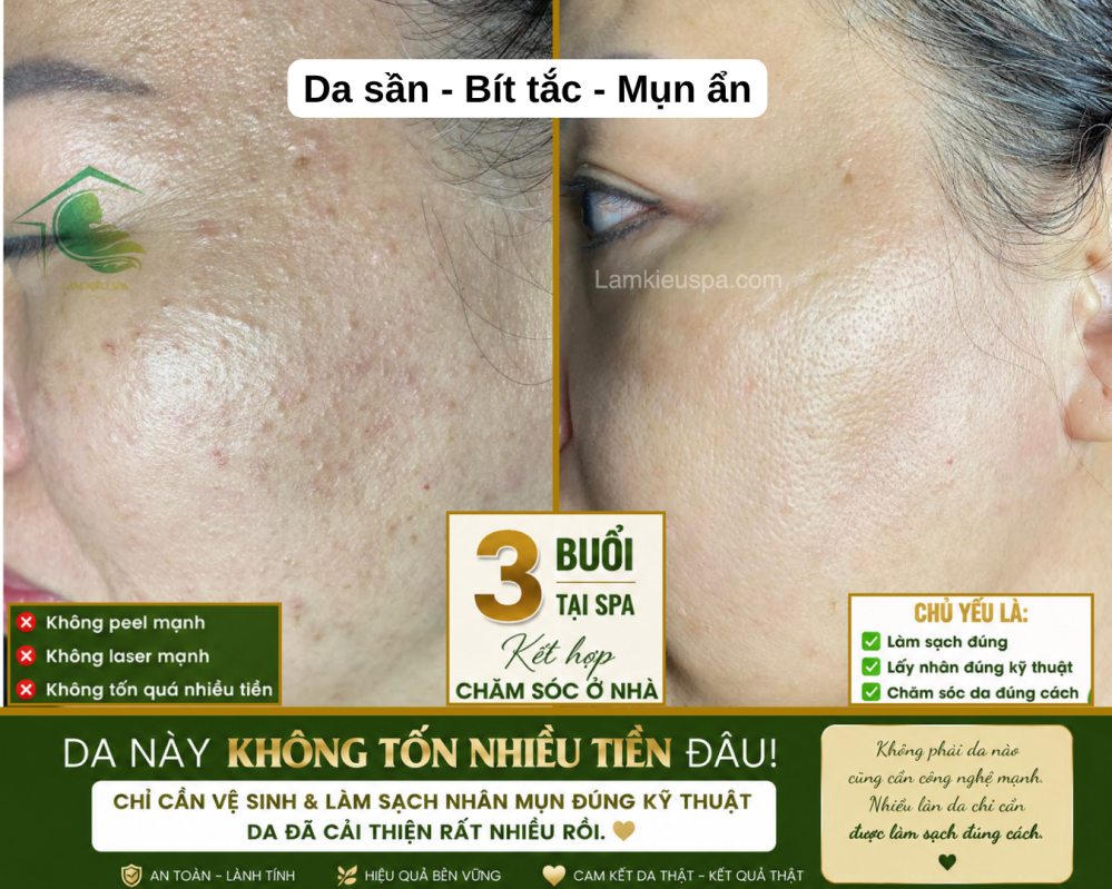 Chăm sóc và trị mụn tại Lâm Kiều Spa Vũng Tàu
