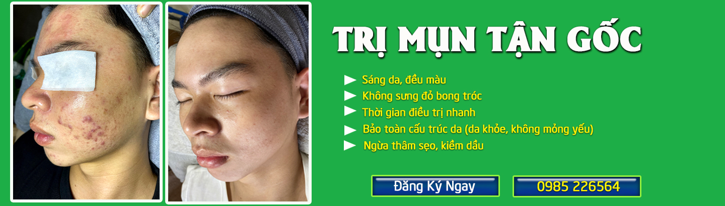 Dịch vụ TRỊ MỤN TẬN GỐC