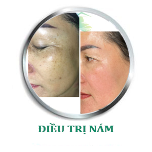 ĐIỀU TRỊ NÁM