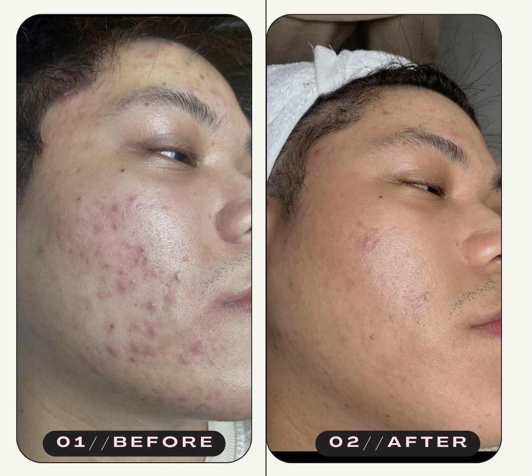 Không được peel mụn