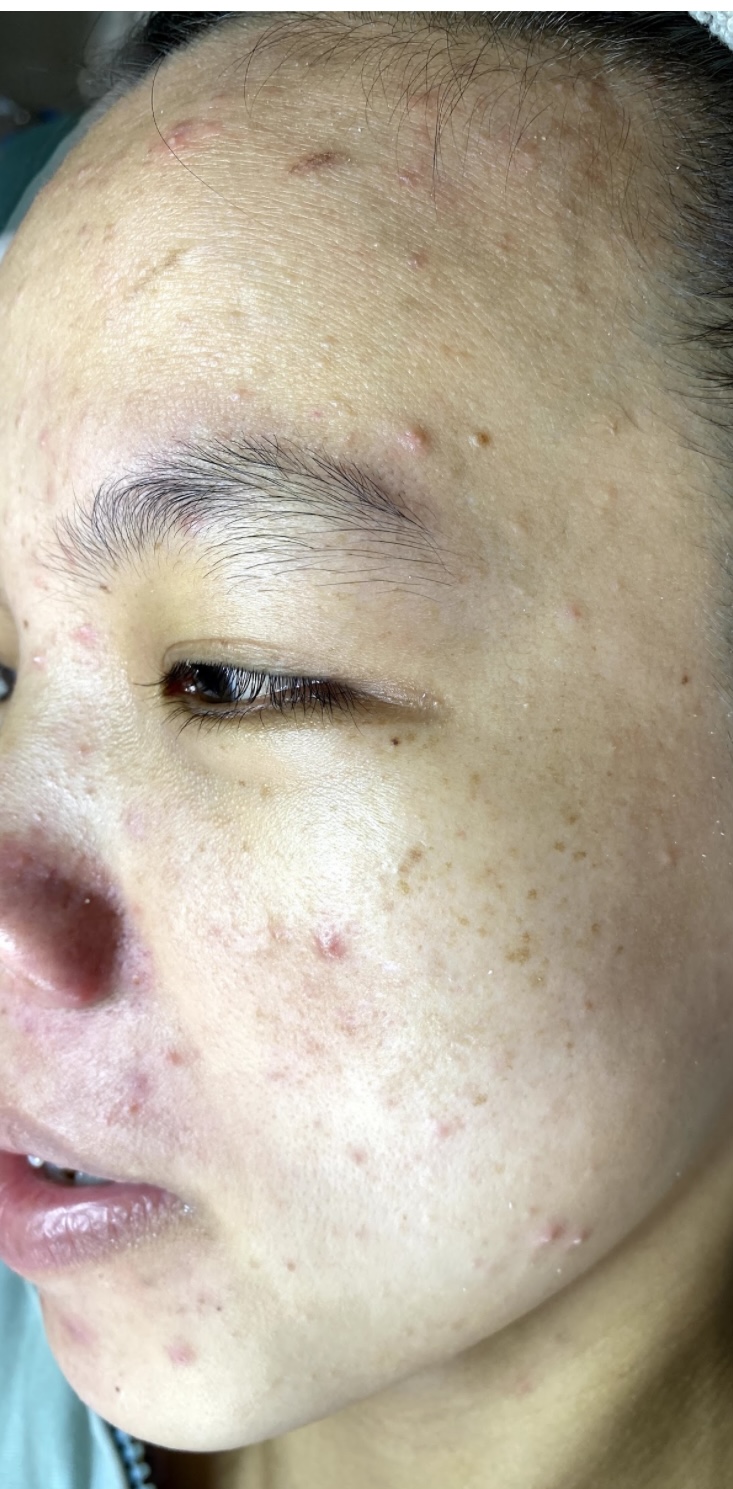 Hình ảnh khách chăm sóc mụn tại Lâm Kiều Spa Tây Ninh 1