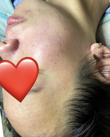 Hình ảnh khách chăm sóc mụn tại Lâm Kiều Spa Tây Ninh 4