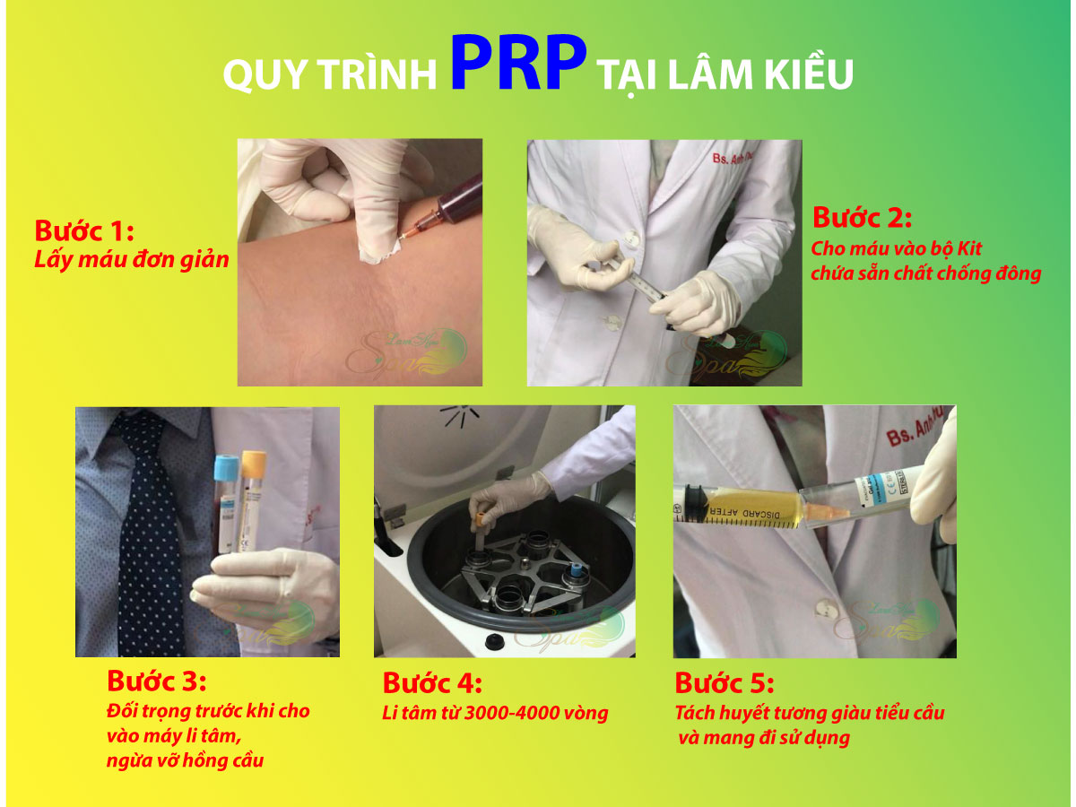 QUY TRÌNH PRP TẠI SPA LÂM KIỀU