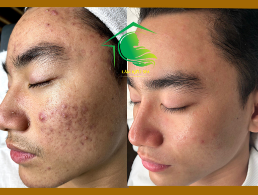 Chăm sóc và trị mụn tại Lâm Kiều Spa Tây Ninh và Vũng Tàu