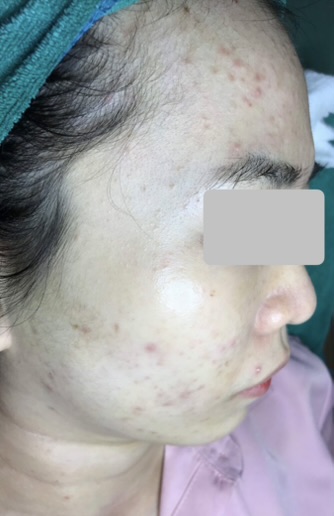 Hình ảnh khách chăm sóc mụn tại Lâm Kiều Spa Tây Ninh 3
