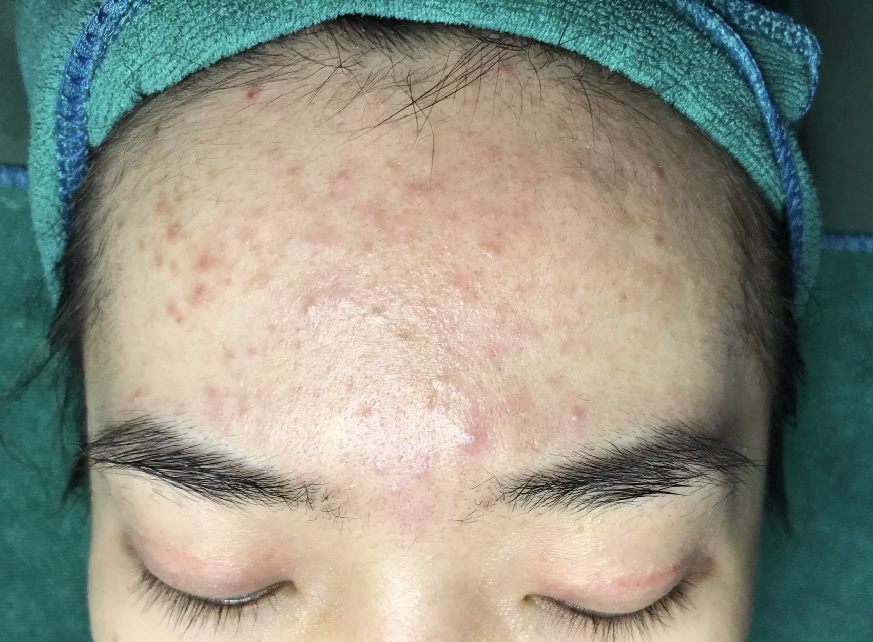 Hình ảnh khách chăm sóc mụn tại Lâm Kiều Spa Tây Ninh 1