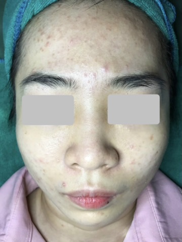 Hình ảnh khách chăm sóc mụn tại Lâm Kiều Spa Tây Ninh 2