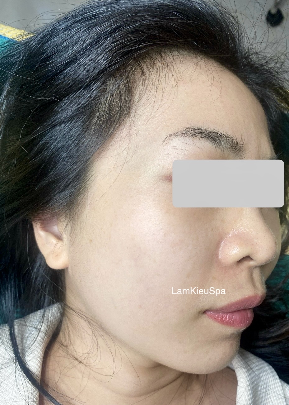 Hình ảnh khách chăm sóc mụn tại Lâm Kiều Spa Tây Ninh 5