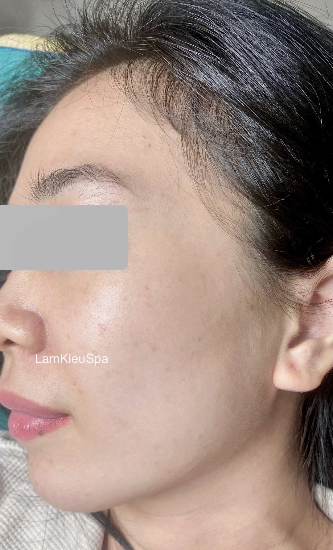 Hình ảnh khách chăm sóc mụn tại Lâm Kiều Spa Tây Ninh 6