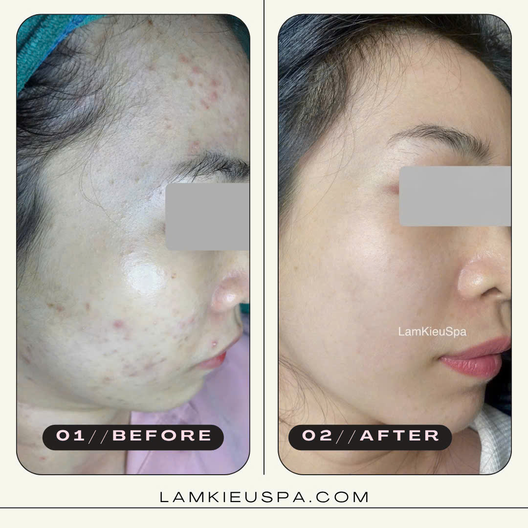 Mụn kích ứng trên nền da yếu