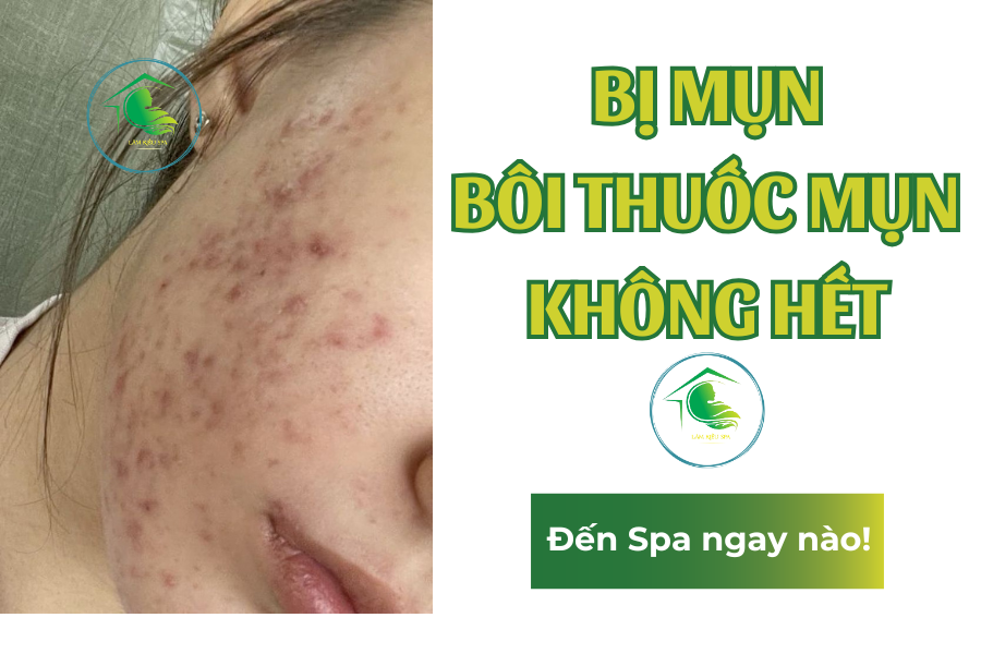 Minh họa chăm sóc và lấy nhân mụn đúng tình trạng
