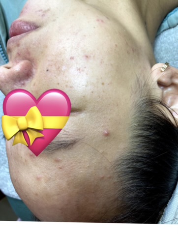 Hình ảnh khách chăm sóc mụn tại Lâm Kiều Spa Tây Ninh 3