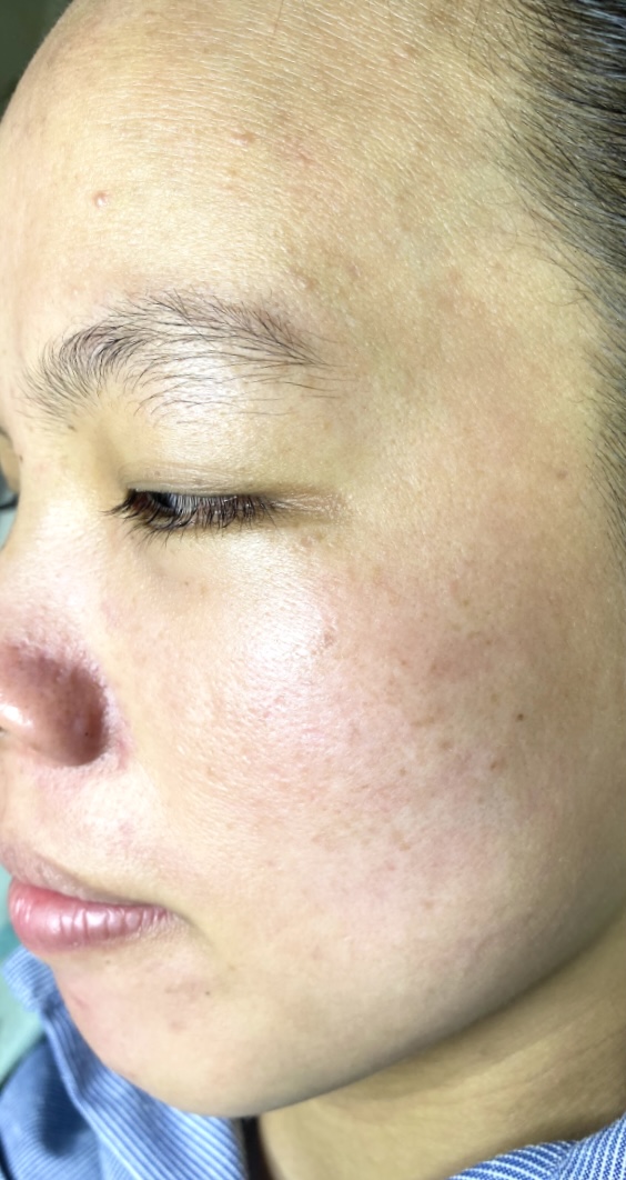 Hình ảnh khách chăm sóc mụn tại Lâm Kiều Spa Tây Ninh 2
