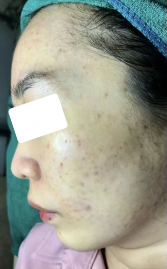 Hình ảnh khách chăm sóc mụn tại Lâm Kiều Spa Tây Ninh 4