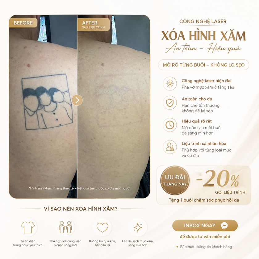 Xóa hình xăm body